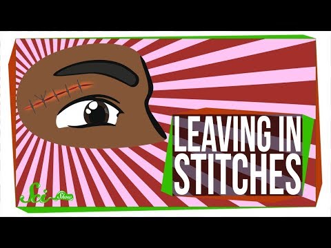 What Happens If You Leave Stitches in for Too Long?