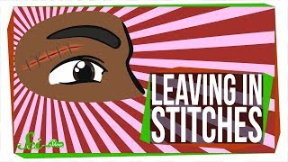 What Happens If You Leave Stitches in for Too Long?