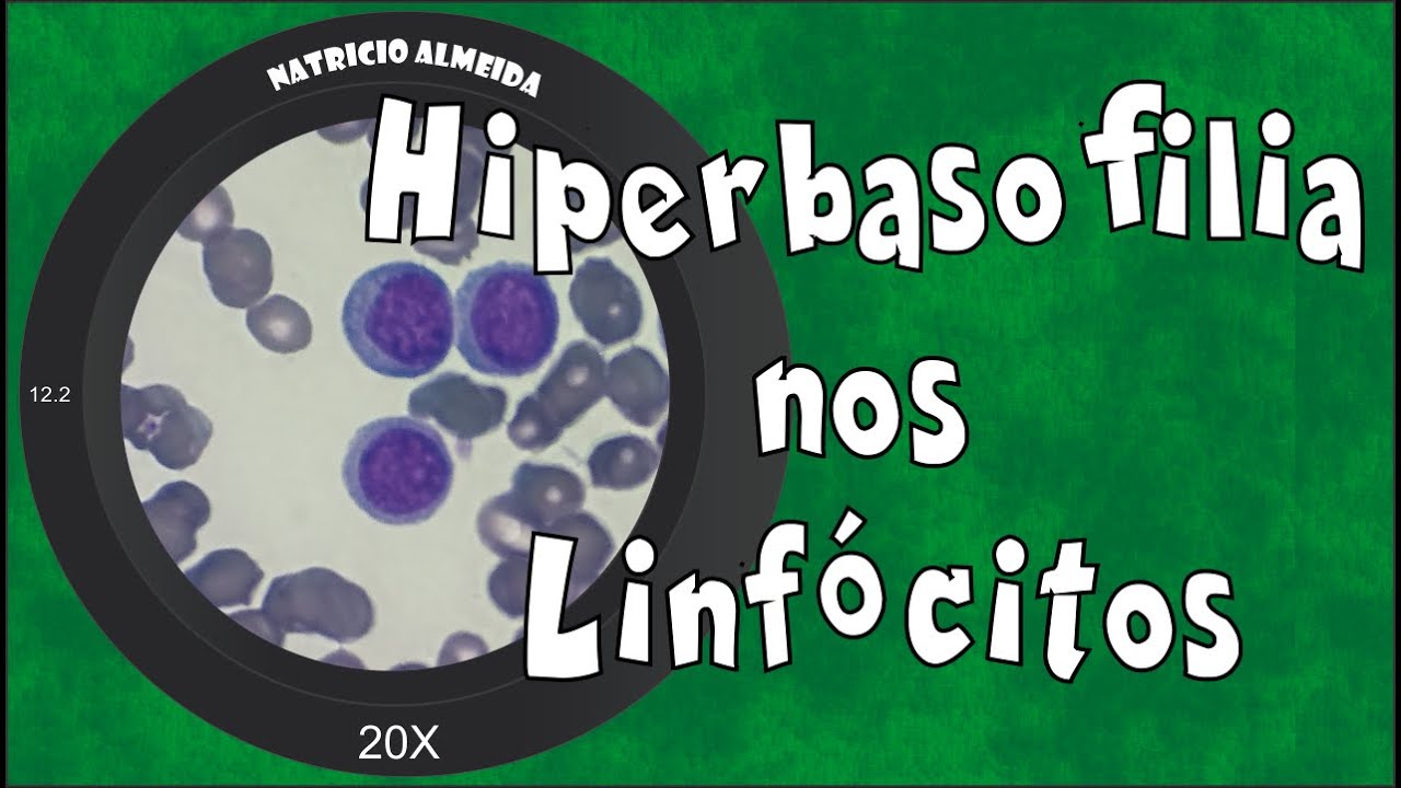 Hiperbasofilia nos linfócitos| Como é um linfócito atípico por hiperbasofilia citoplasmática