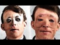 The Tragic History of WW1 Plastic Surgery
