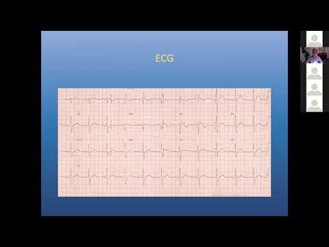 6 24 20 Wylie Brugada Syndrome