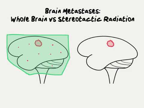 Doctor Explains Whole Brain Radiation versus Stereotactic Radiosurgery for Brain Metastases