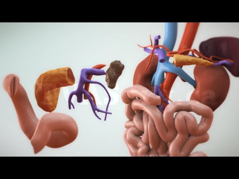 Pancreatico-duodonectomy (Whipple procedure) with SMA/SMV reconstruction