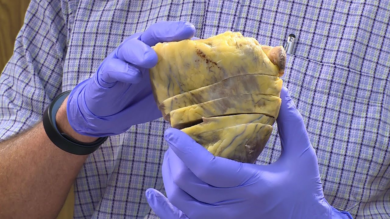 Heart transplant recipient sees old heart