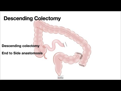 HCC 1475 10k  Surgical Anatomy Desc colectomy