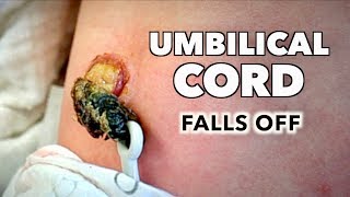 UMBILICAL CORD FALLS OFF AN OOZING BELLY BUTTON (2 Week Old Baby) | Dr. Paul