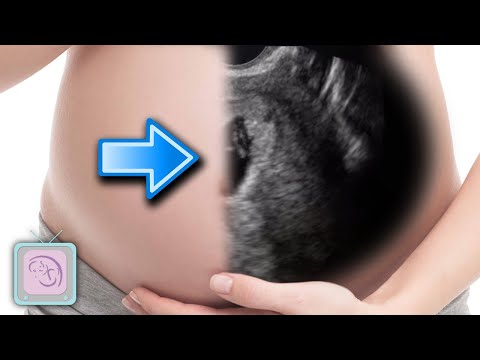 How to predict if you will have an early miscarriage (with ultrasound)
