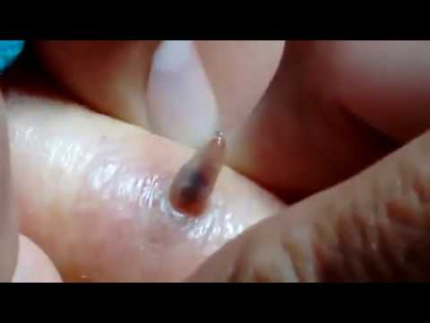 gyermek férgek kezelése népi gyógyszerekkel hány pinworms él egy emberben