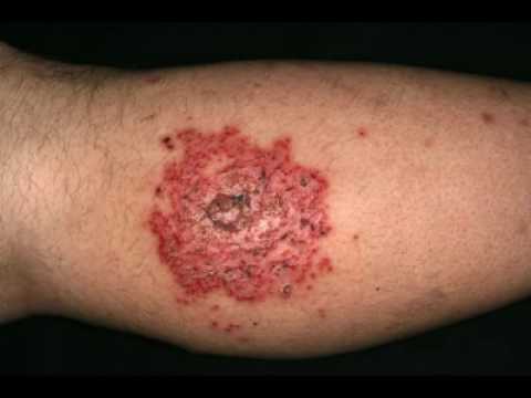 Dermatite di atopic su sintomi di mani e trattamento di una fotografia Eczema di corno sulle dita