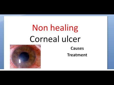 Ophthalmology 114 a Non healing corneal ulcer Cornea Causes Treatment