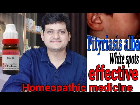 Homeopathic medicine for white spot on face of children ? बच्चों के चेहरे में सफेद दाग !