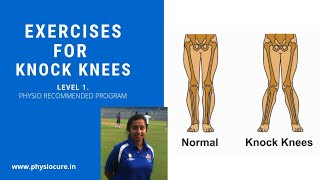 Exercises For Knock Knees