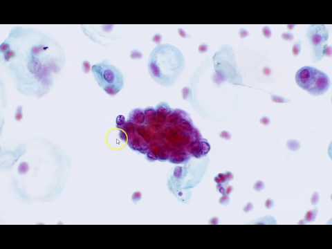 Cervical cytology - Endometrial cells