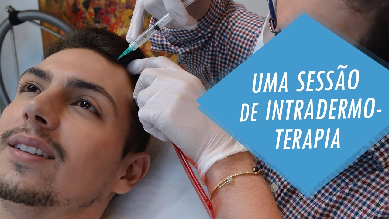 (VLOG) Intradermoterapia: Dê Adeus a Calvicie - uma sessão comigo!
