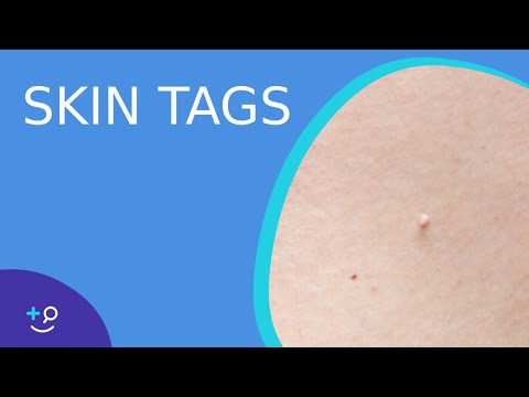 Skin Tags - What they are and how to treat them