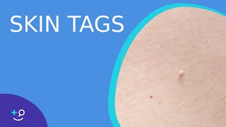 Skin Tags - What they are and how to treat them