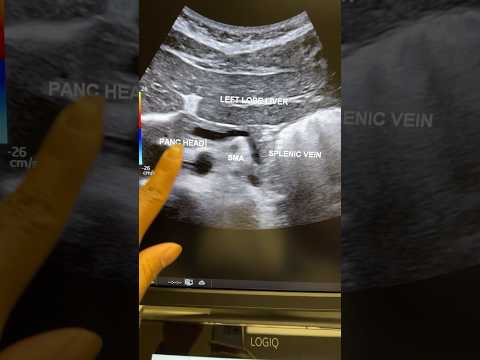 How to image the pancreas via ultrasound! #ultrasound #pancreas #sonography