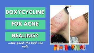 Antibiotics for acne doxycycline   FOREHEAD ACNE CAUSES