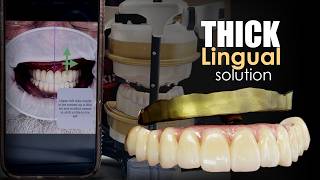 Challenging Implant Case with Thick Lingual