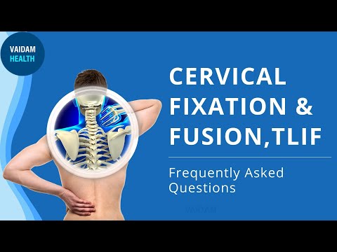 Cervical Fixation and Fusion TLIF - Frequently Asked Questions
