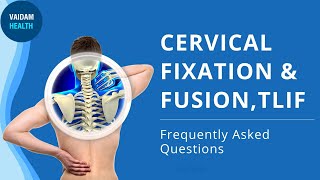Cervical Fixation and Fusion TLIF - Frequently Asked Questions