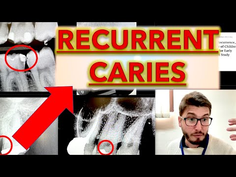 Recurrent CARIES FOR BEGINNERS: Decay Diagnosis and Dental Treatment (Restorative Dentistry)
