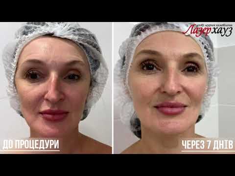 Мезороллер Perfoskin - микроигольчатая терапия, направлена на омоложение и улучшение состояния кожи