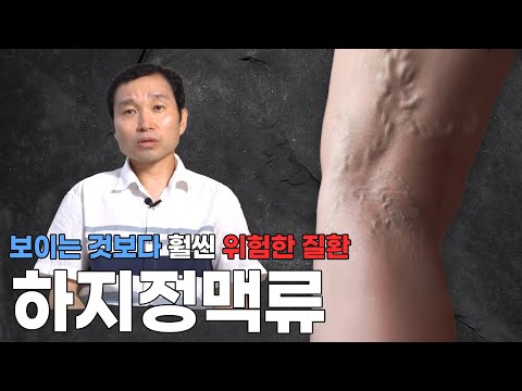 생각보다 위험한 하지정맥류! 급사까지 할 수 있다?! 수술과 예방법 모두 알려드려..
