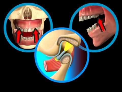 Osteocondrosi e massaggi banche silicone Più il costo del giunto