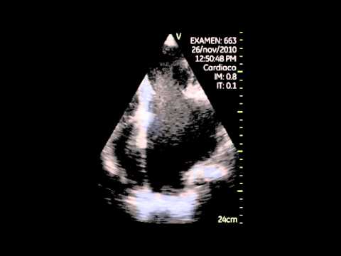 Spontaneous Echo Contrast