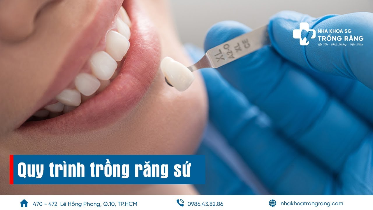 Quy trình trồng răng sứ thẩm mỹ theo 7 bước tiêu chuẩn