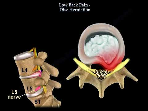 A Comprehensive Look at Low Back Pain: Disc herniation