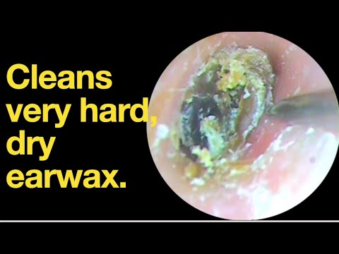 Cleans very hard, dry earwax. |ear wax removal | ear cleaning | ASMR | relaxation | relax