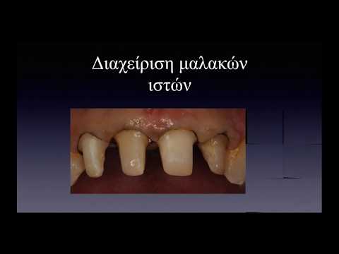 Αποτυπώσεις που κερδίζουν τις εντυπώσεις. Impression to Impress. (DentalTTT - Webinar Νo.48).