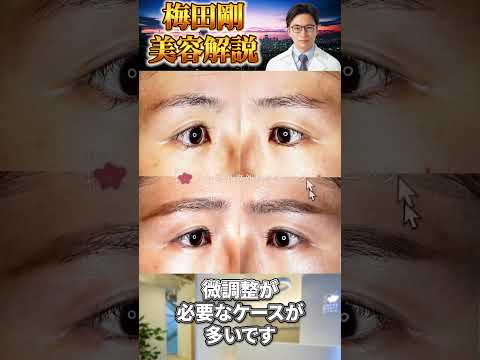 医学科 過矯正を下げる手術「挙筋後転」│他院修正 #うめだ美容外科クリニック #他院修正 #挙筋後転
