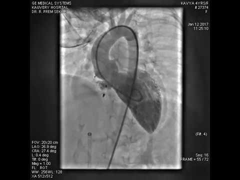 Device closure of perimembranous VSD without arteriovenous loop formation.