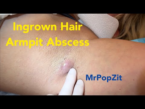Ingrown hair armpit abscess. Surprising amount of hair and discharge expressed! Incision & drainage
