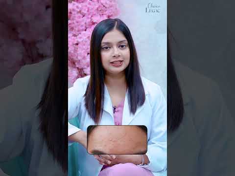 How do I know if I have fungal acne? Dr. Farzana Boby #dermatologist #fungalacne #skincareroutine