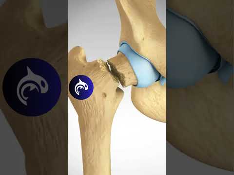 See what happens in a Femoral Neck Fracture and ORIF