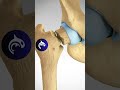 See what happens in a Femoral Neck Fracture and ORIF