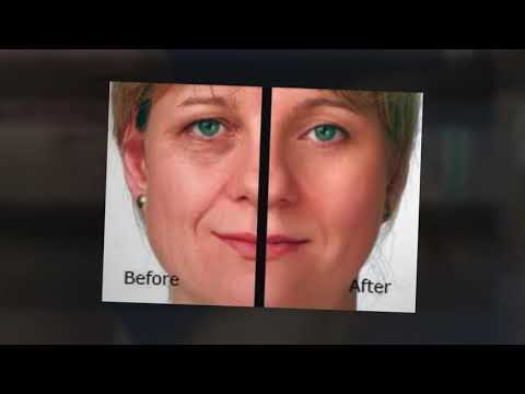 download lagu mp3 mp4 Stretch Mark Removal New York, download lagu Stretch Mark Removal New York gratis, unduh video klip Stretch Mark Removal New York