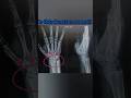 Is this fracture or not? #medicalimaging #xray #radiology