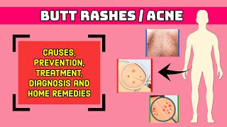 Butt Rashes I Prevention, Treatment, Home Remedies, Pain Relief I Booty Acne I Buttocks Acne I Itchy