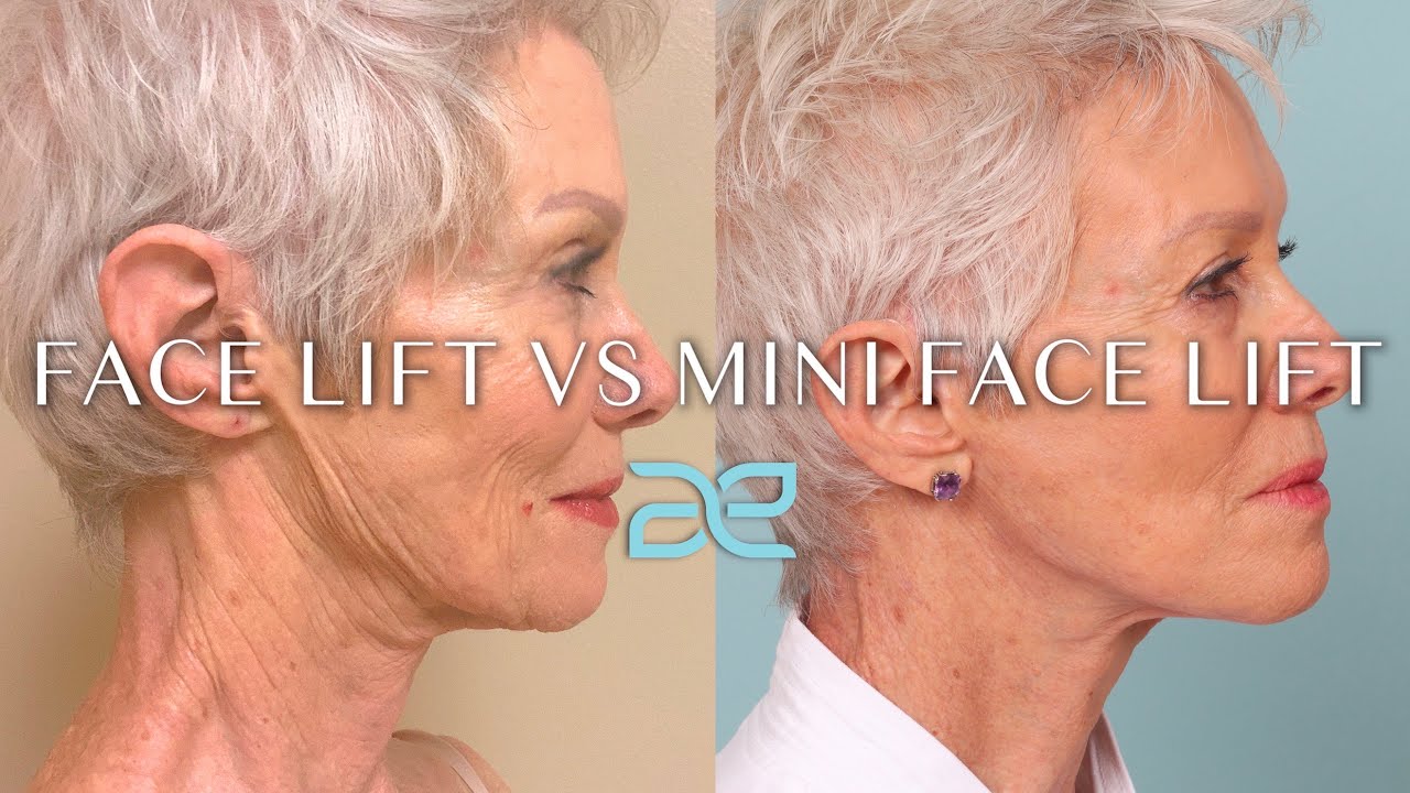 Image of Before and after a facelift