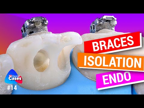 Braces, Isolation And RCT - Clinical Case