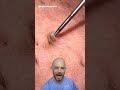 Satisfying Impacted Hair Removal From The Armpit Credit Blemishbandits On TT Doctor Satisfying