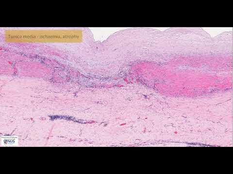Aorta: Syphilitic aortitis - Virtual microscopy (Talking slide)