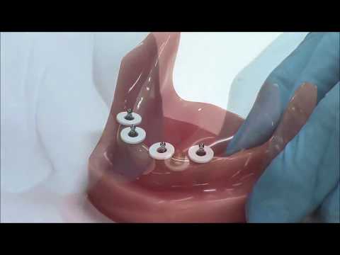Sterngold Dental's MOR® Mini Implant System