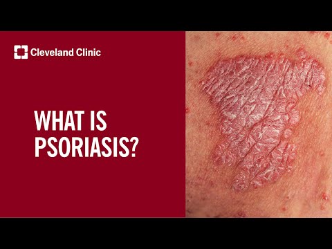 What Is Psoriasis?
