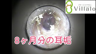 耳掃除動画vol.76「8ヶ月分の耳垢」